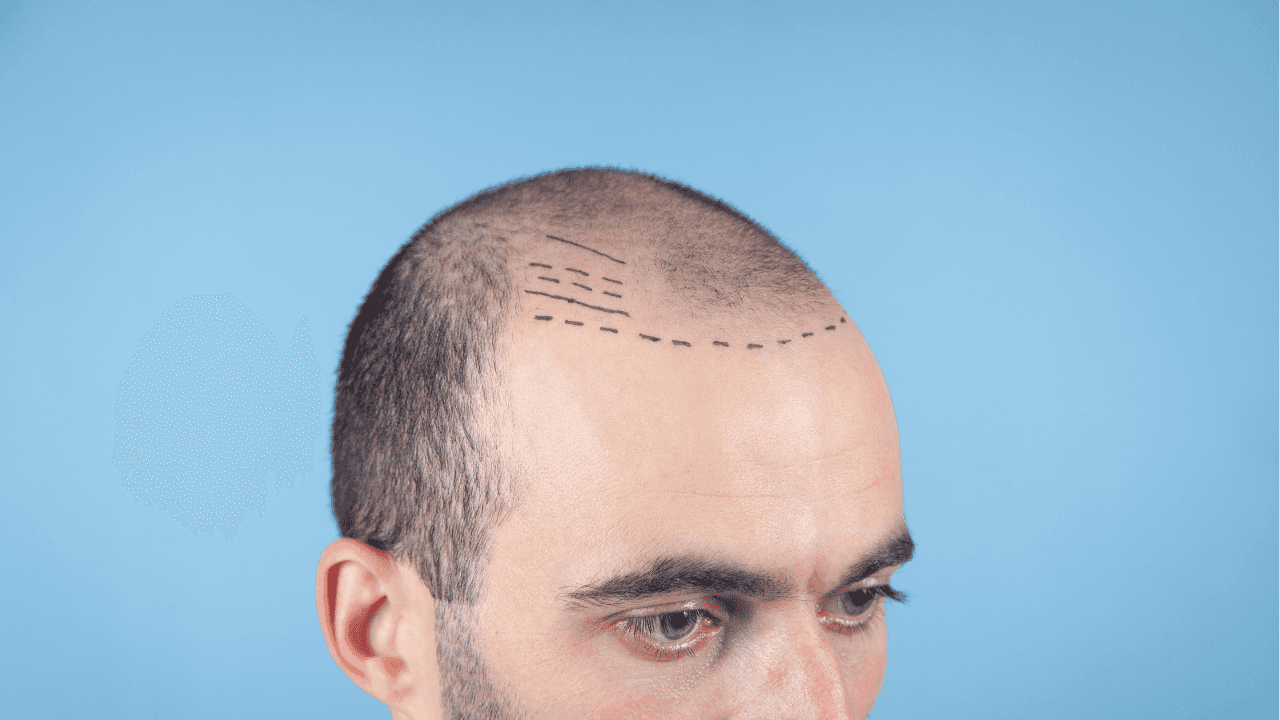 Cost of Hair Transplant in Korea (Seoul) | Price of All FUE & FUT Procedure Types