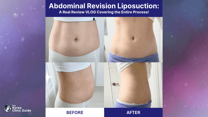 Ein persönlicher Erfahrungsbericht über eine Korrektur-Liposuktion am Bauch in Korea