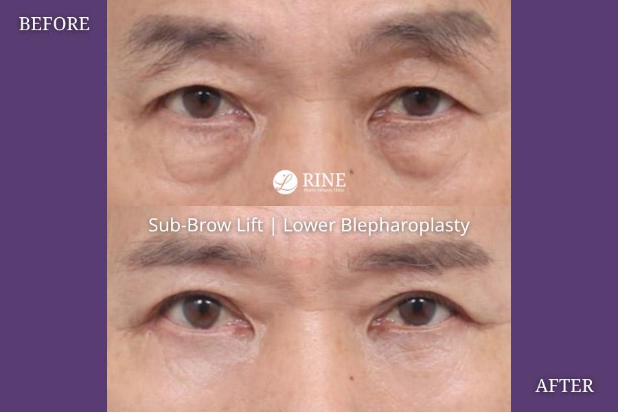 Sub Brow lift lower blepharoplasty