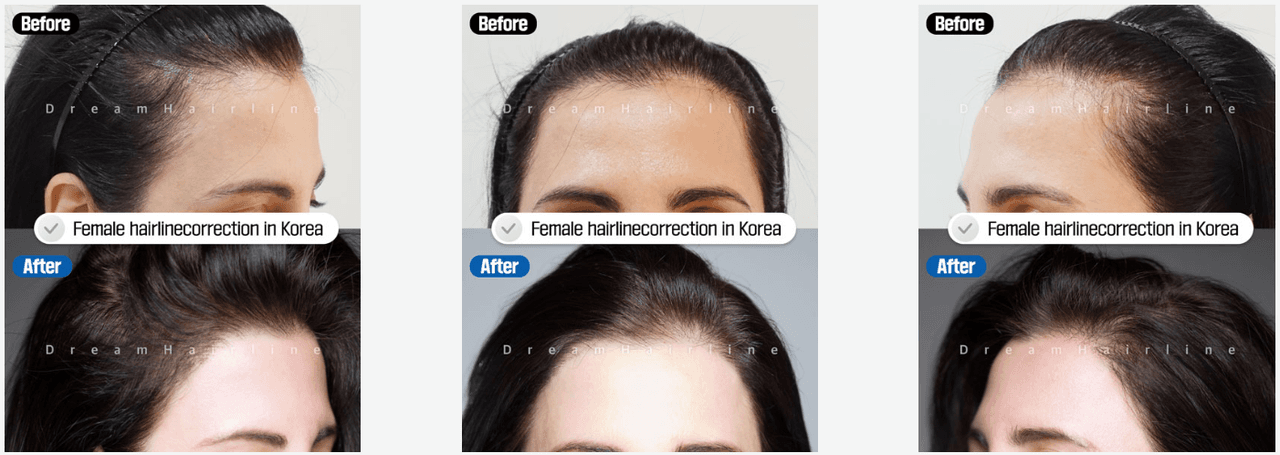 Before and After Hairline Correction