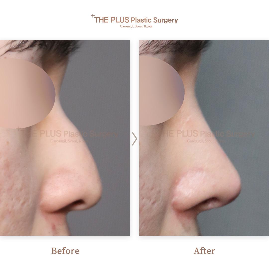 Primary Rhinoplasty & Nose Implant & Nasal Tip Plasty & Ear Cartilage & Septal Cartilage & Nasal Septum Deviation Correction & Sinus Surgery & Nose Osteotomy