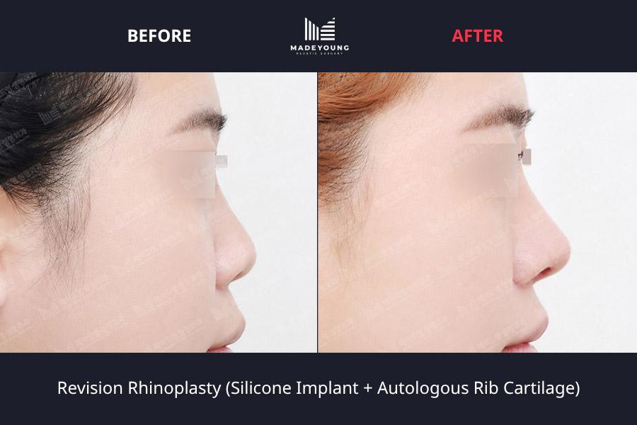 Rhinoplasty silicone implant autologous rib cartilage