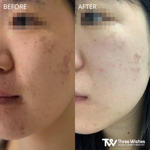 Acne Treatment