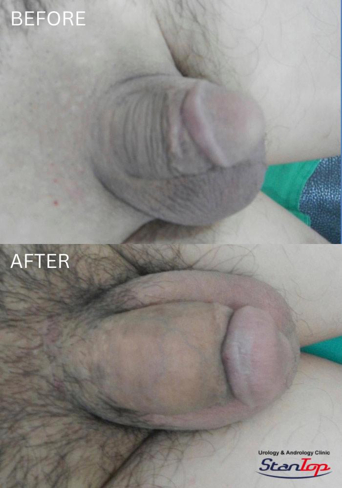 Penis Enlargement