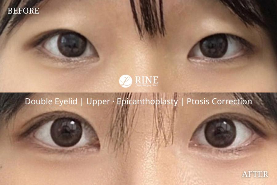 Double Eyelid upper canthoplasty epicanthoplasty ptosis correction