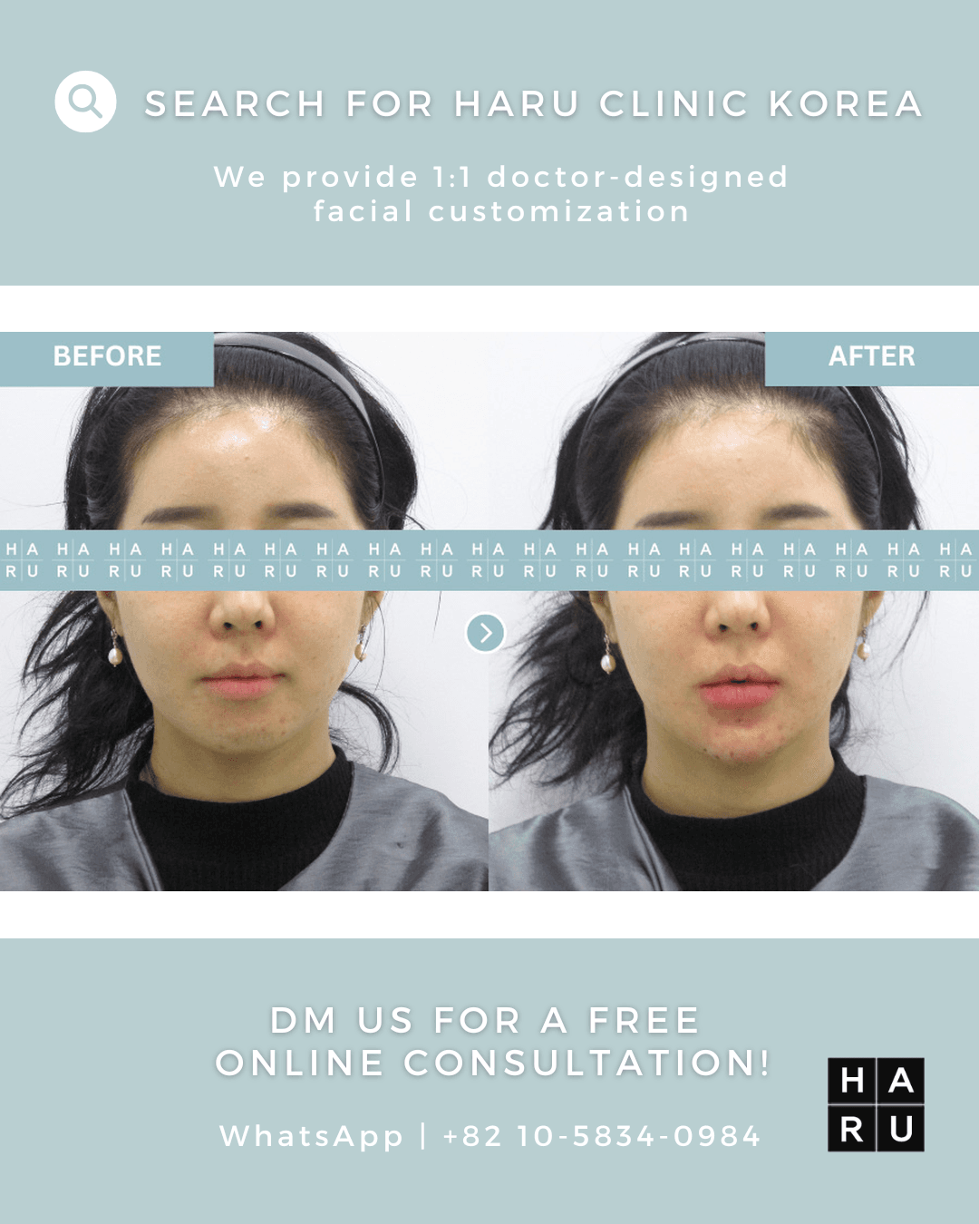 Kinnfiller, Kinn-Botox, fettauflösende Injektion