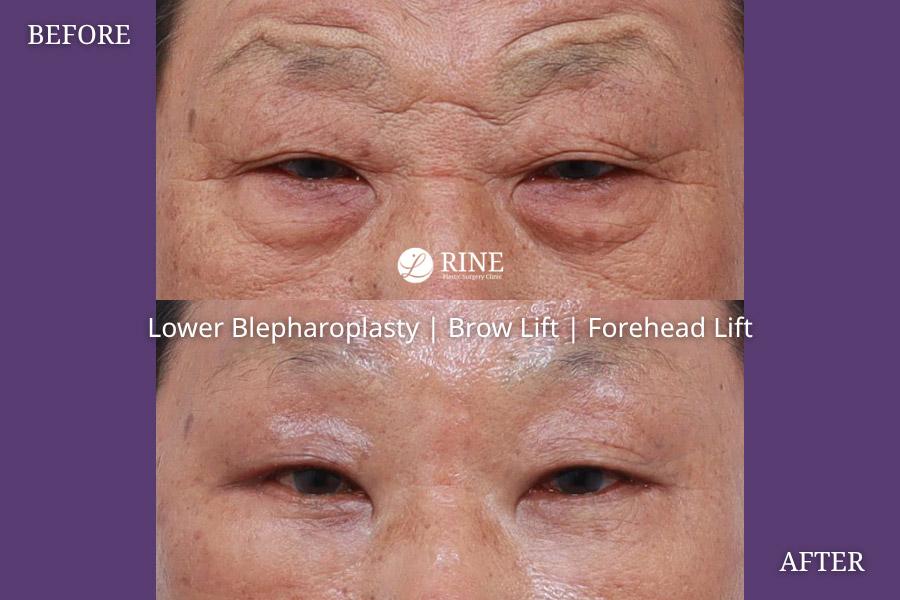 Lower Blepharoplasty brow lift forehead lift