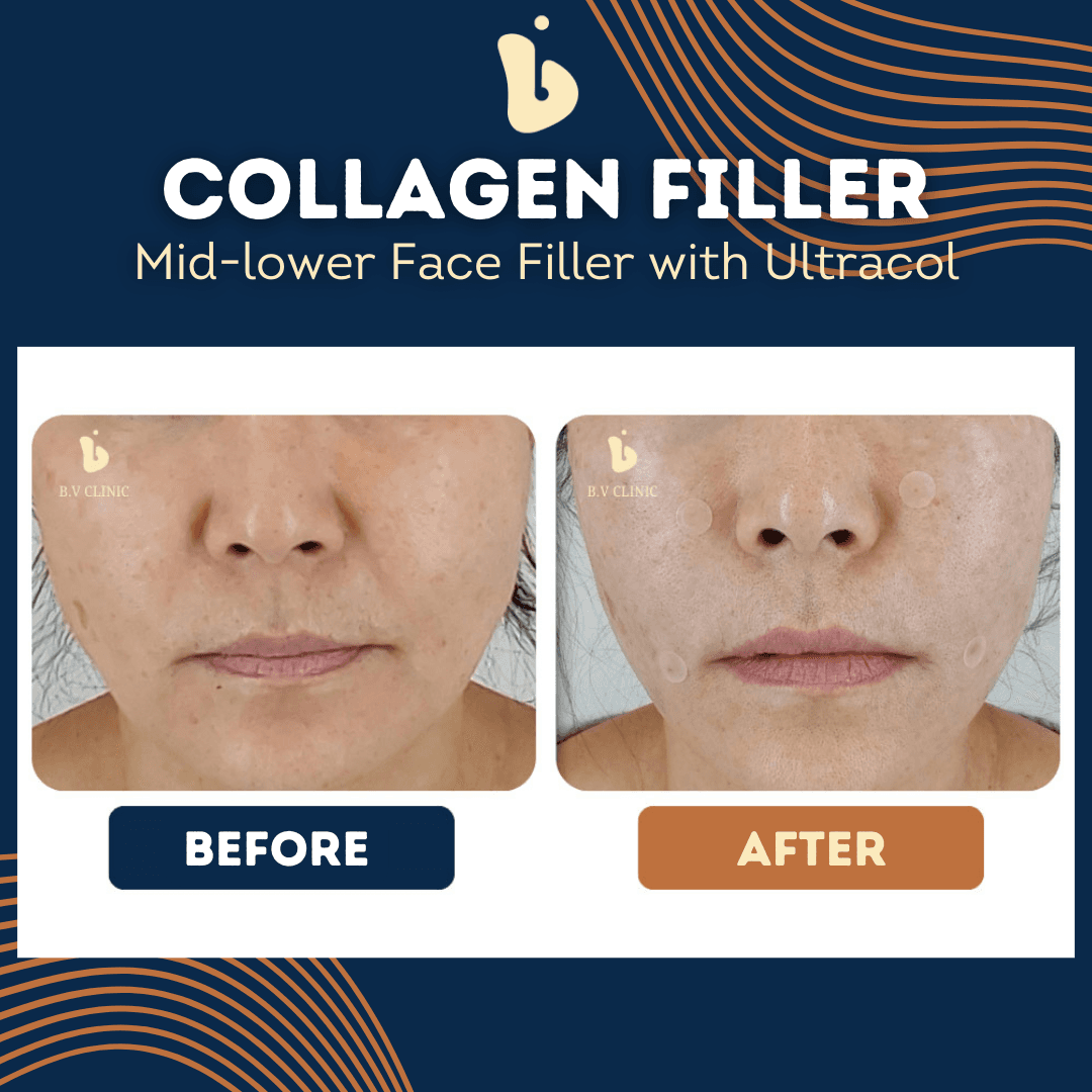 B.V Clinic before and after image