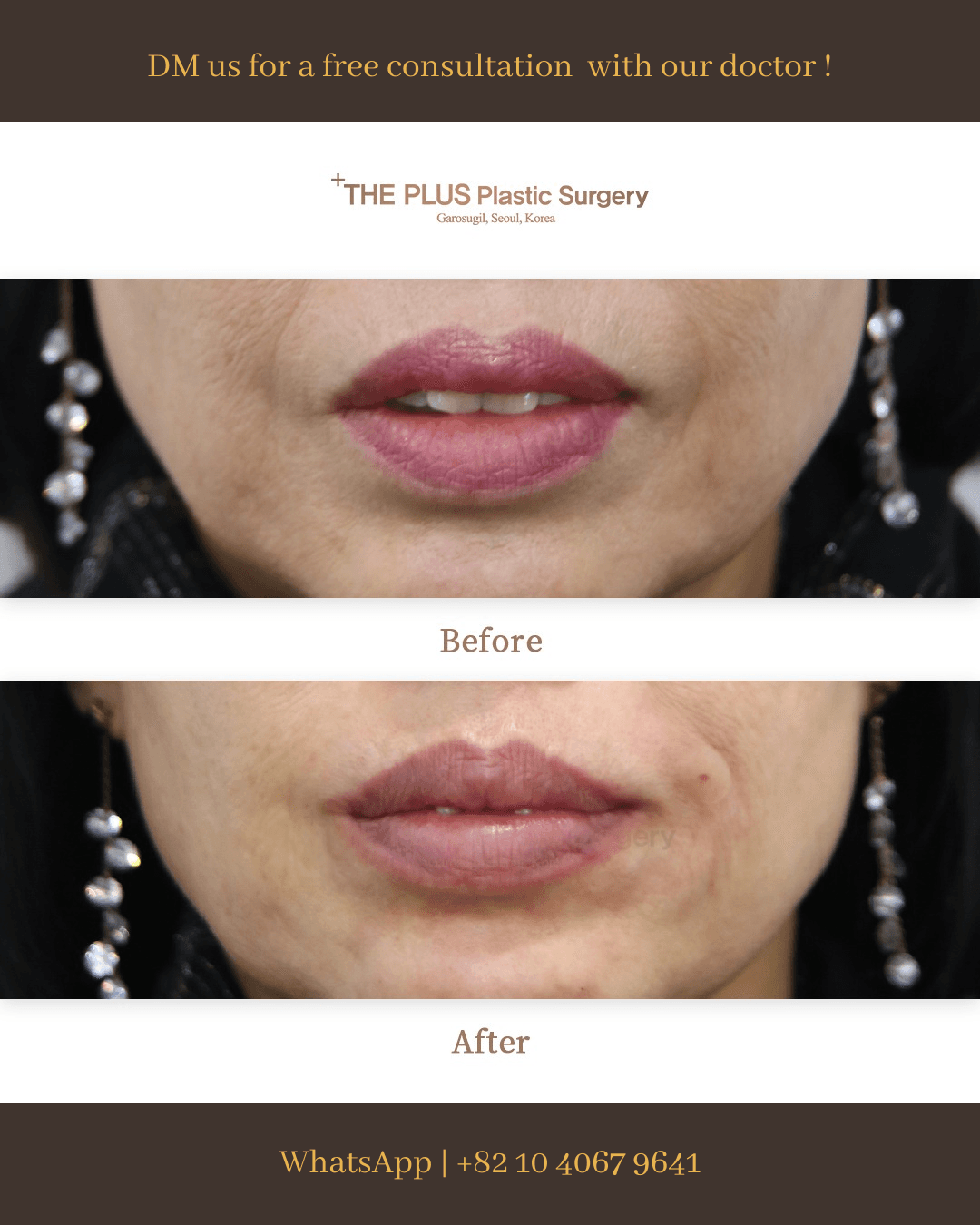 Mundwinkel-Lift mit Botox
