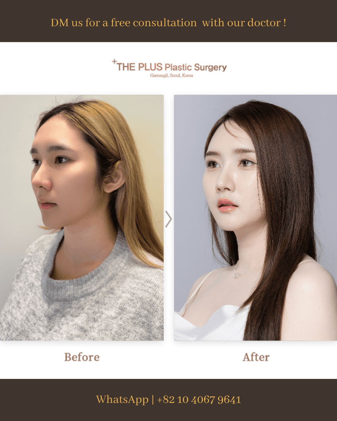 Face Contouring, Cheekbone Reduction, Face Fat Grafting, Endotine Lift, Forehead Lift