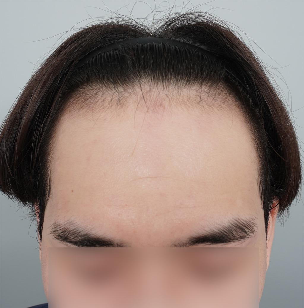 Haartransplantation • Zusätzliche Behandlung: PRP-Behandlung bei Haarausfall • Nachher: 371 Tage postoperativ • Details: 4.000 Grafts (Haarlinie, M-Form) + PRP