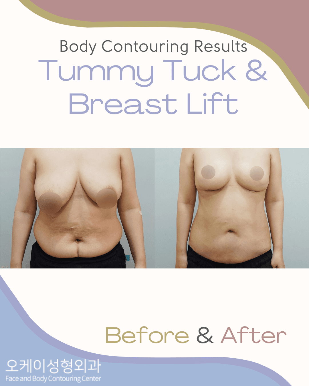 Okay Plastic Surgery Clinic before and after image