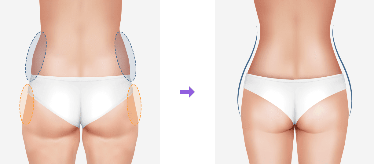 Hip Dip Fat Grafting