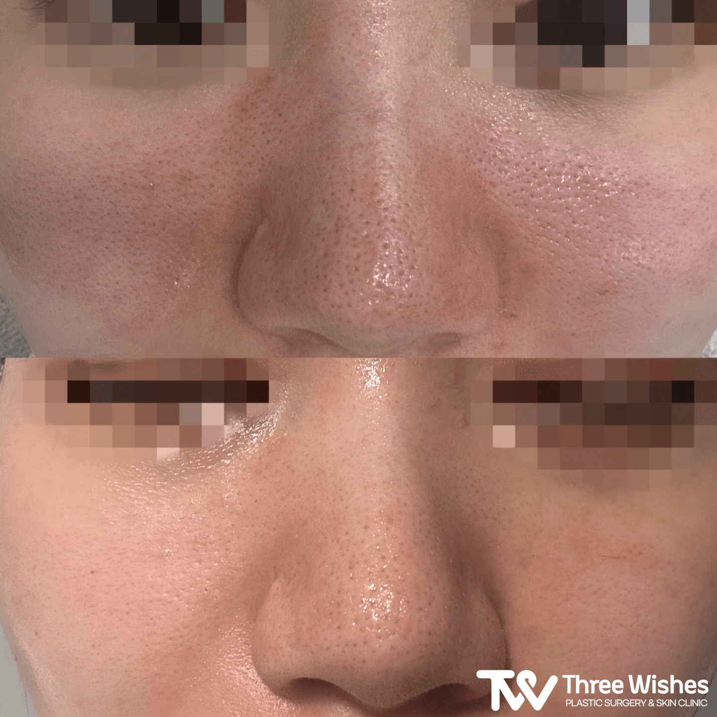 Nose Pore Treatment