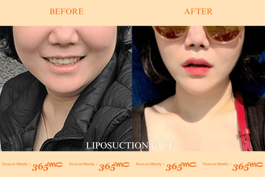 Liposuction - face