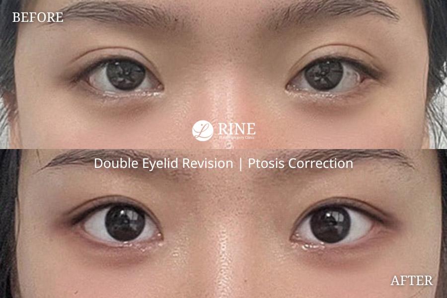 Double Eyelid revision ptosis correction