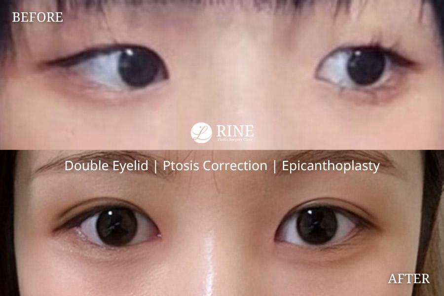 Double Eyelid ptosis correction epicanthoplasty
