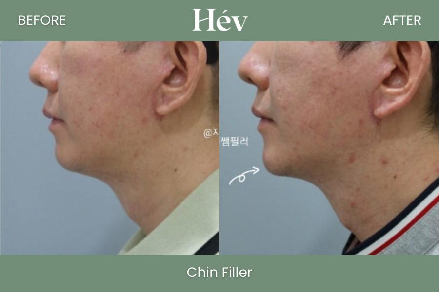 Chin Filler