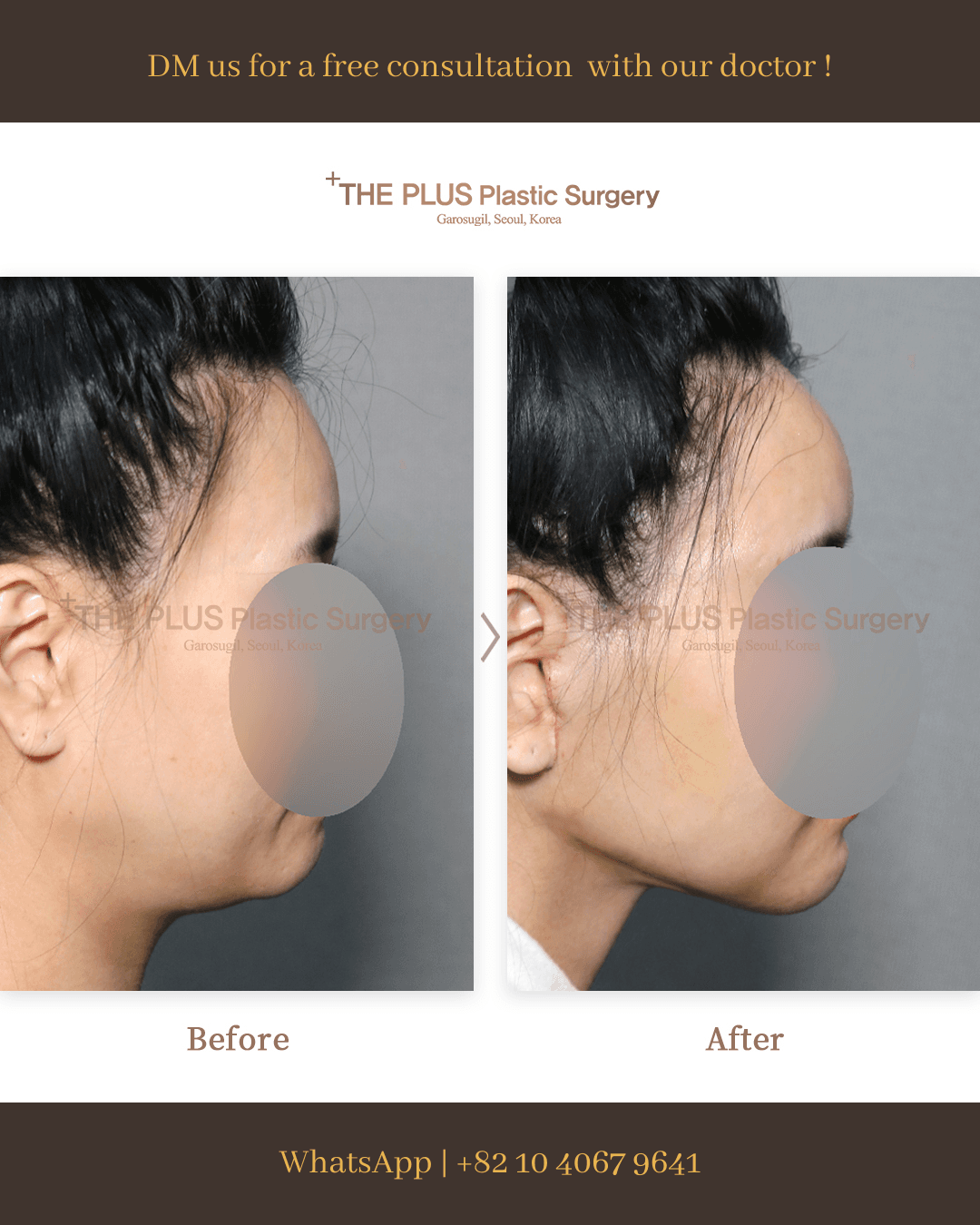 Face Lift, Face Contouring, Thread Lift, Double Chin Tightening