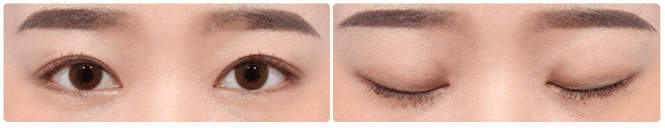 Vorher-Nachher-Bild von Made Young Plastic Surgery