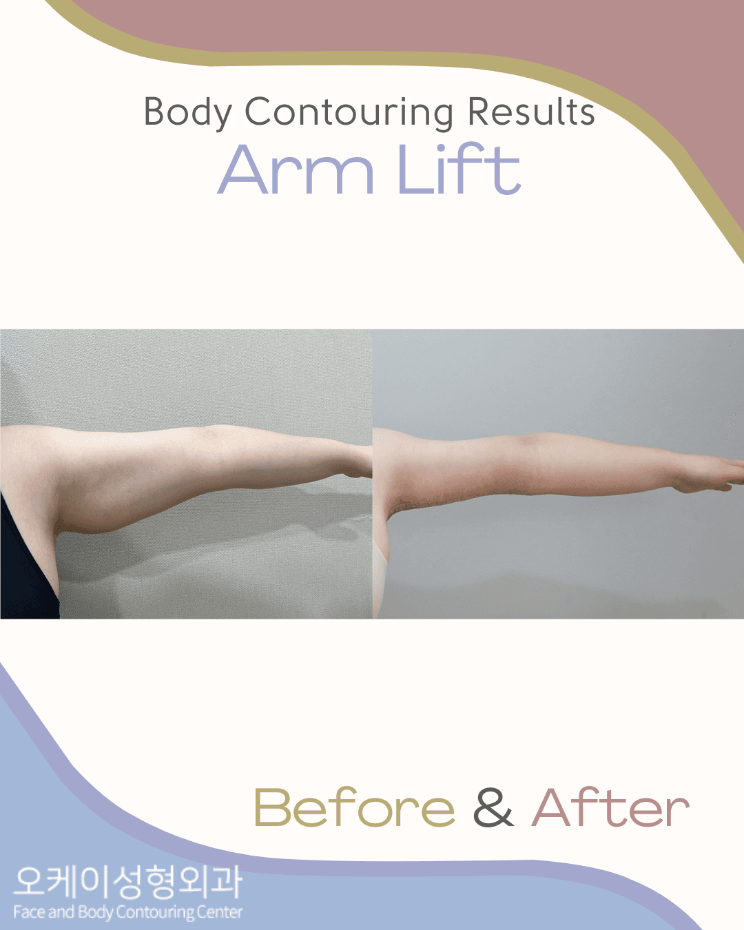 Arm Lift