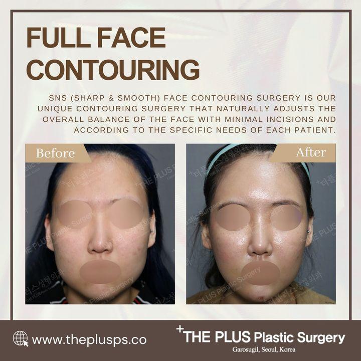 Radiant Transformation: Full Face Contouring at ThePlus! 🌟 Elevate every angle with a comprehensive approach to facial harmony. From sculpting cheekbones to refining jawlines, discover the beauty of a fully contoured face. Ready to unveil your radiant transformation? Let's embark on a personalized journey to enhance your unique features! ►