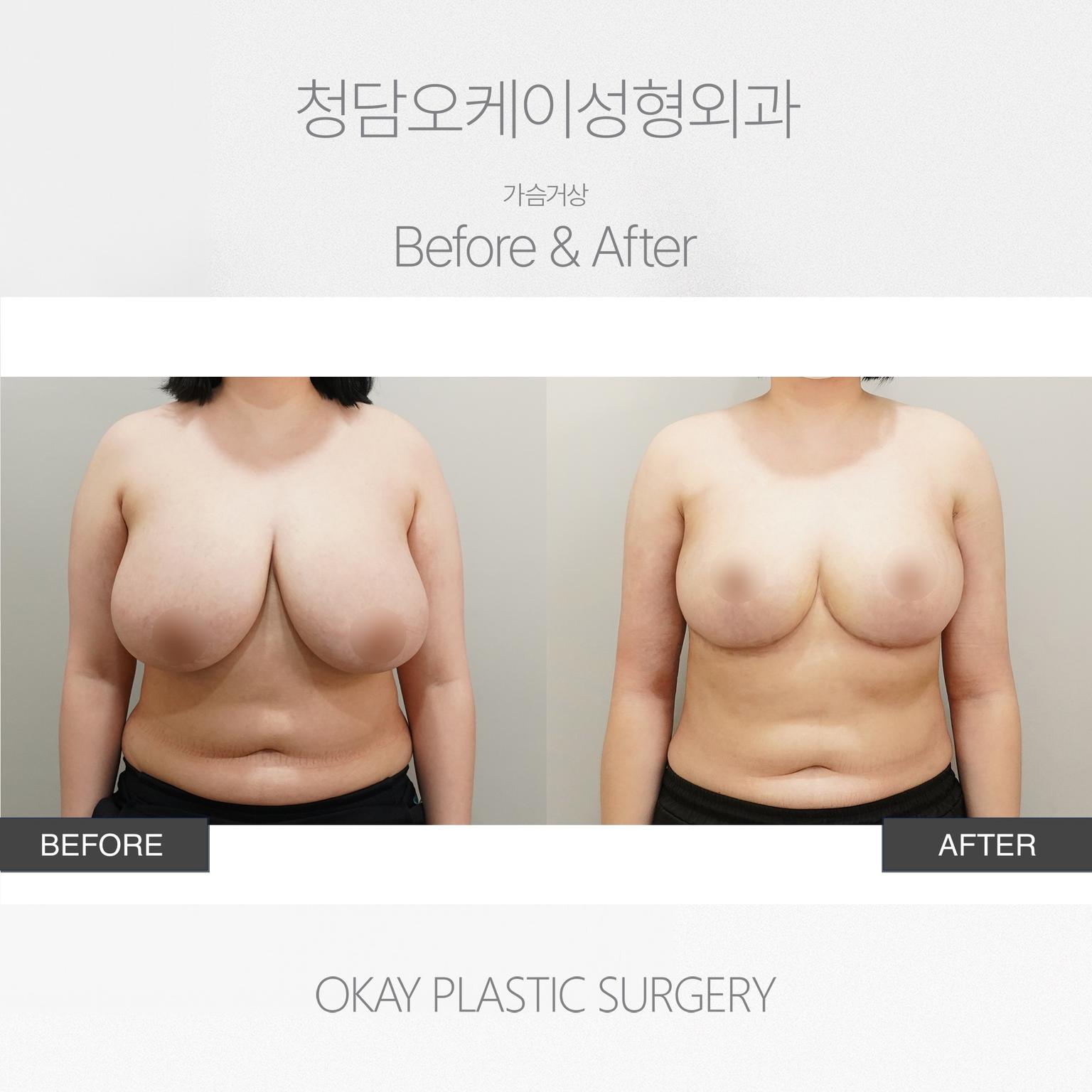 Okay Plastic Surgery Clinic before and after image