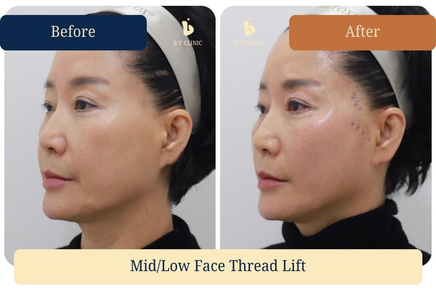Midface and lower face thread lifting. The patient wanted improvement in the nasolabial folds and perioral area. Before and after photos taken on the day of the procedure.