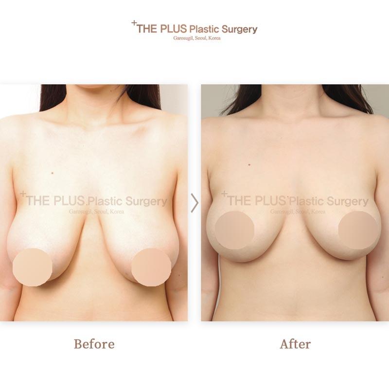 Breast Reduction