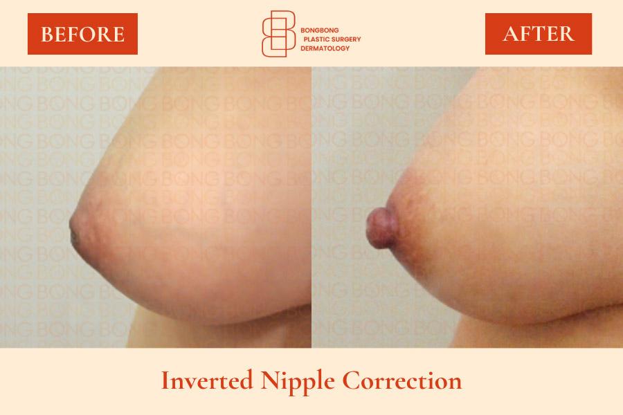 BongBong Plastic Surgery Dermatology before and after image