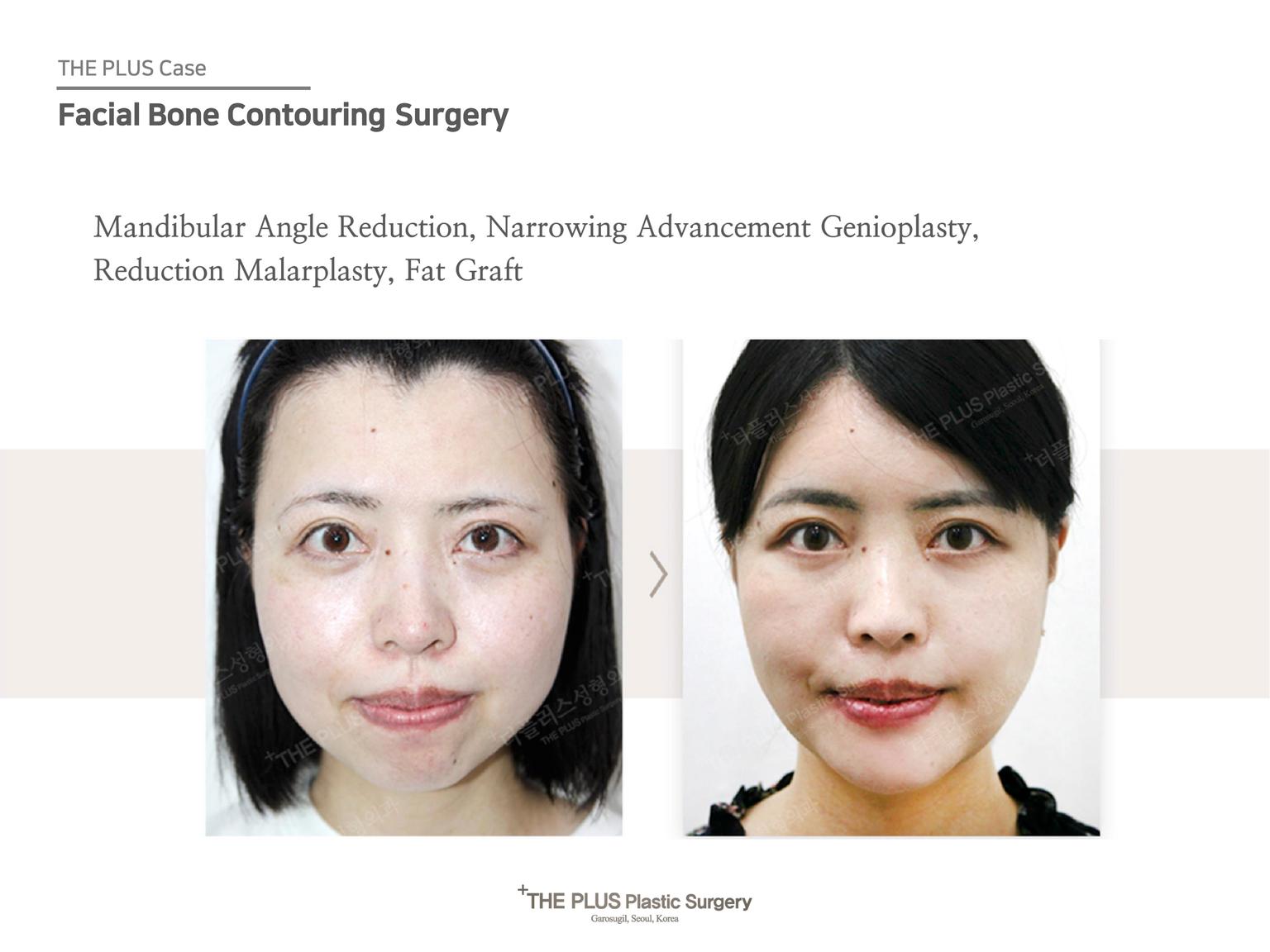 Mandibular Angle Reduction & Narrowing Advancement Genioplasty & Reduction Malarplasty & Fat Graft