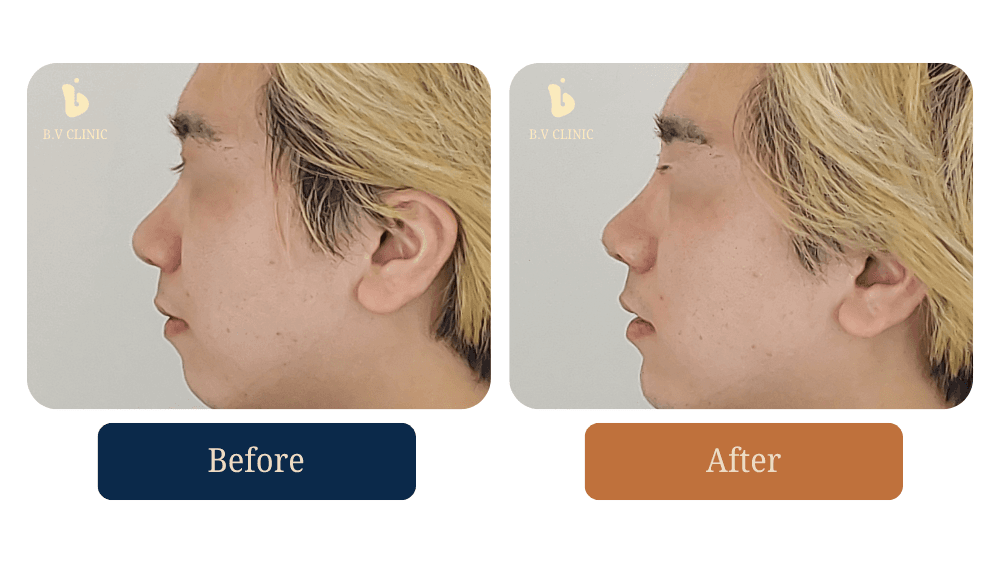 B.V Clinic before and after image