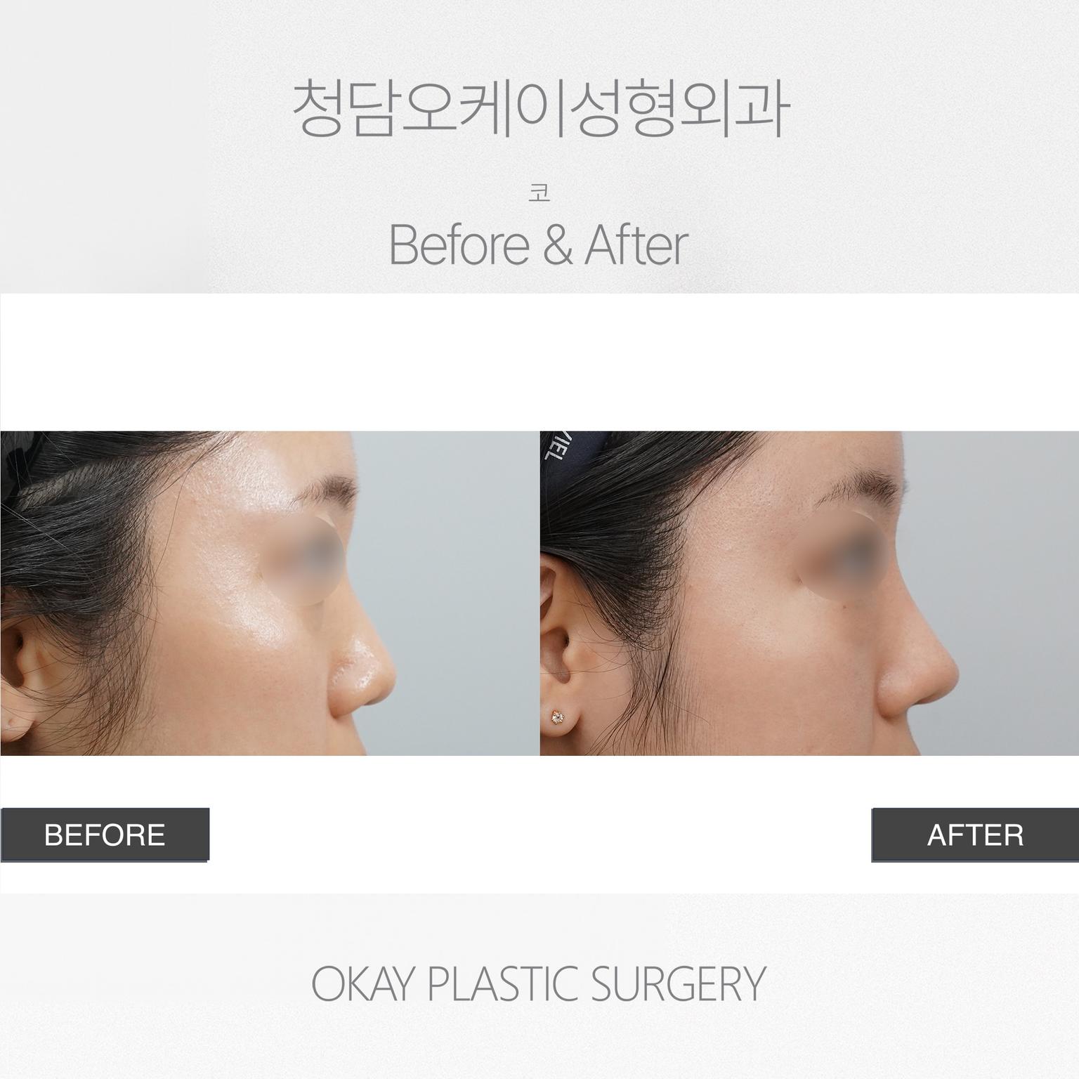 Okay Plastic Surgery Clinic before and after image