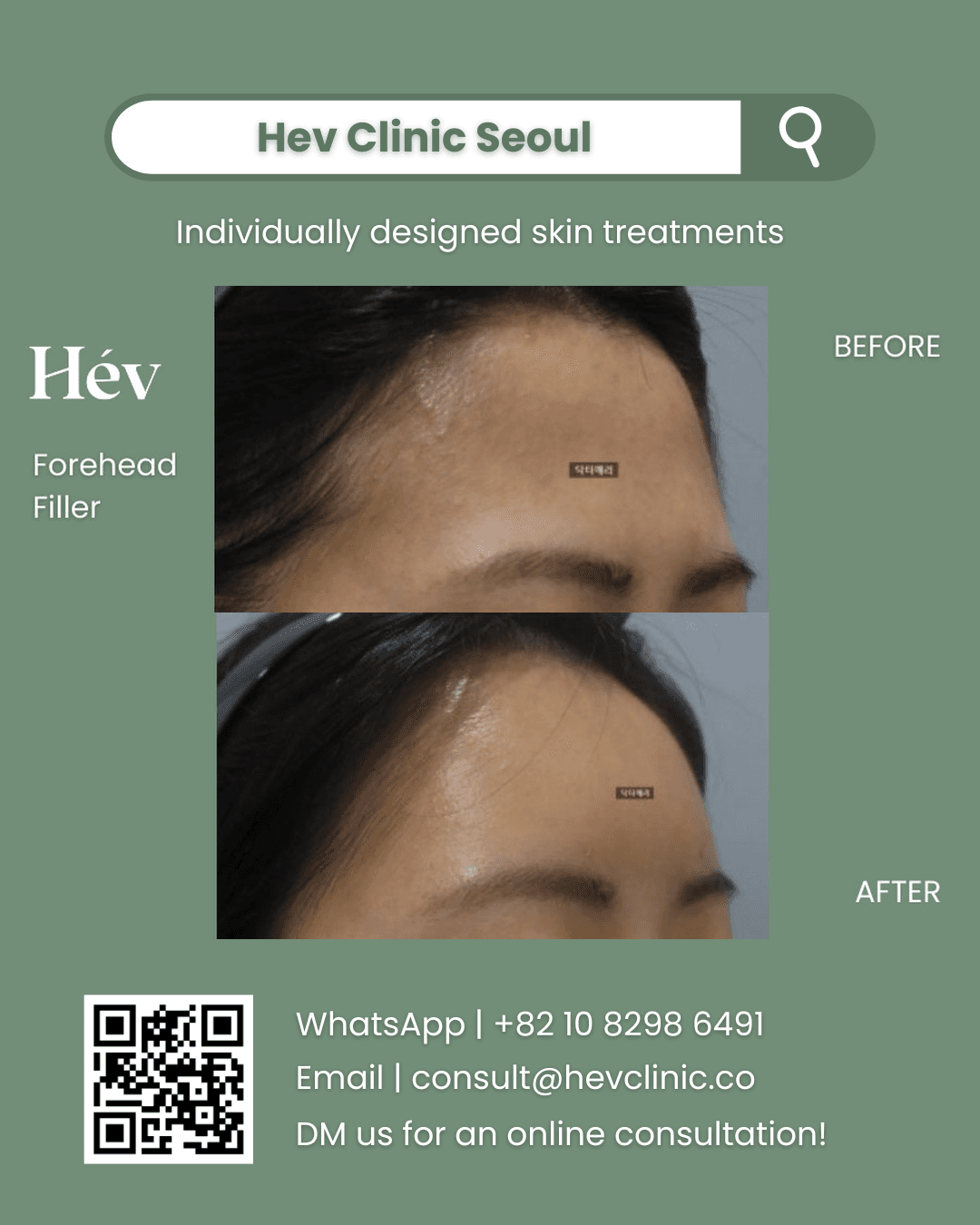 Forehead Filler