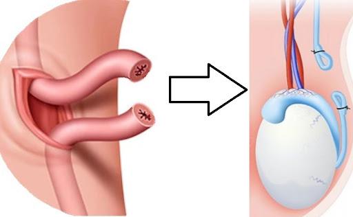 Vasectomy