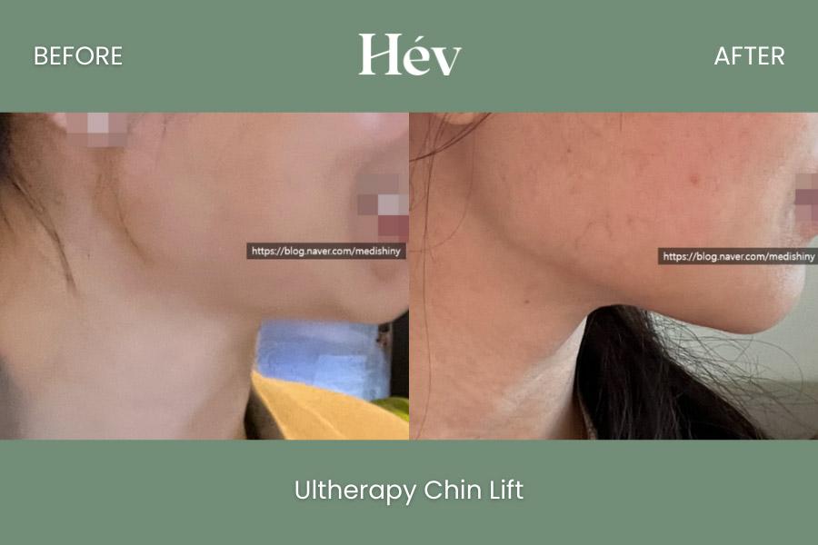 Ultherapy Chin Lift
