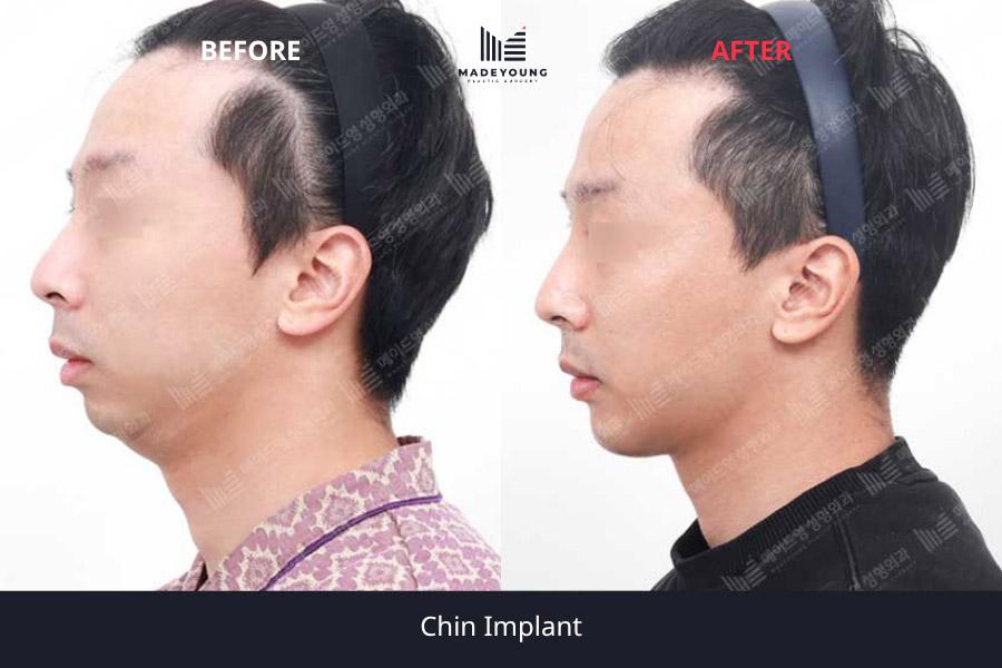 Implant 1