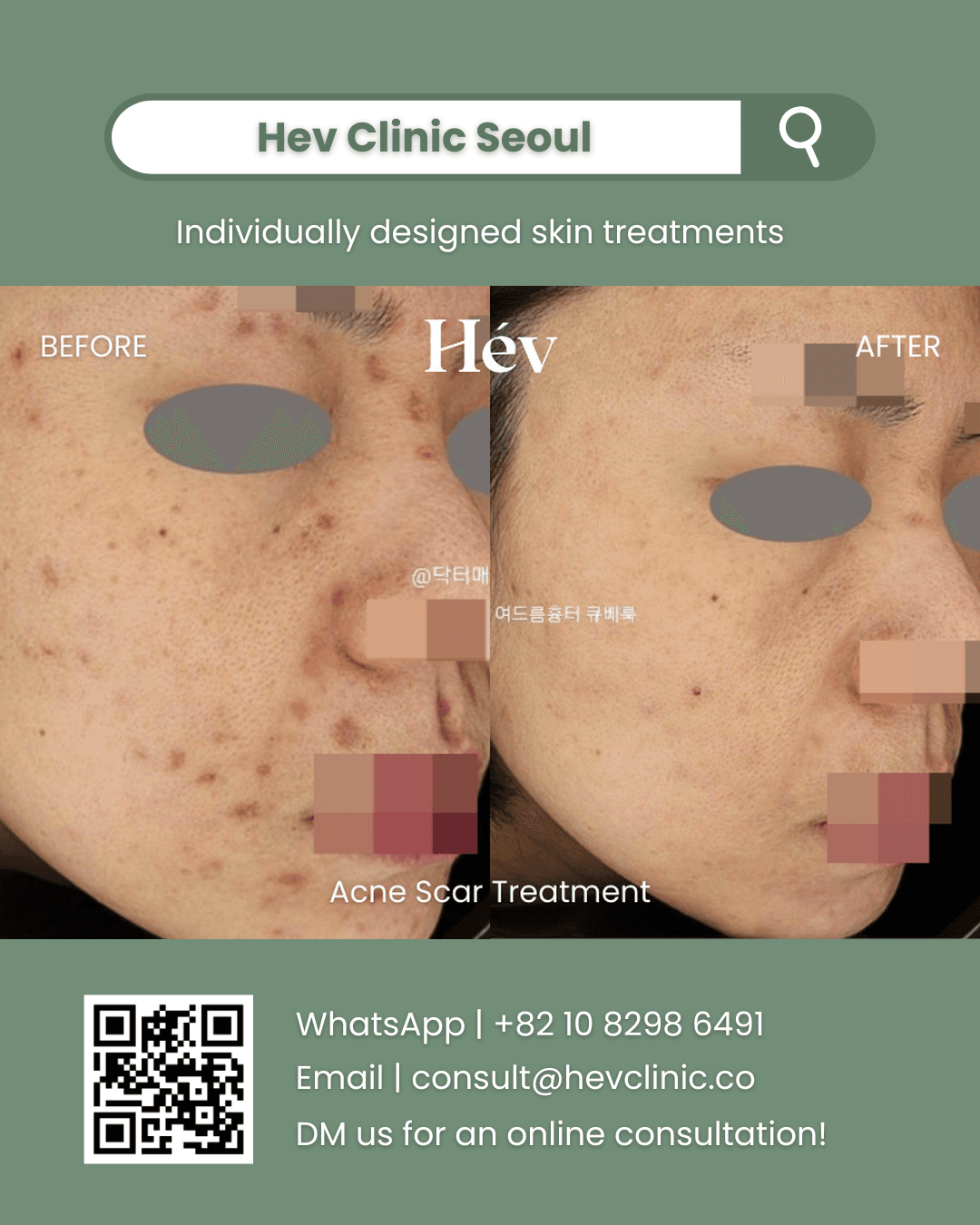 Acne Scar Treatment, Acne Treatment