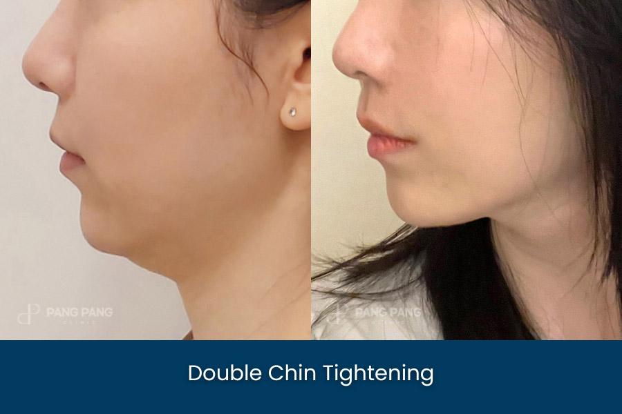 Double Chin Tightening Thread Lifting