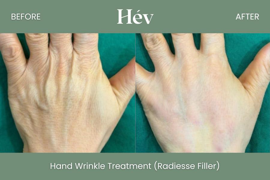 Hand Wrinkle Treatment Radiess Iller