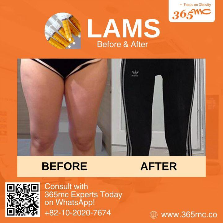 Experience the future of liposuction with LAMS. Minimally invasive, maximally effective. Begin your transformation at 365mc.