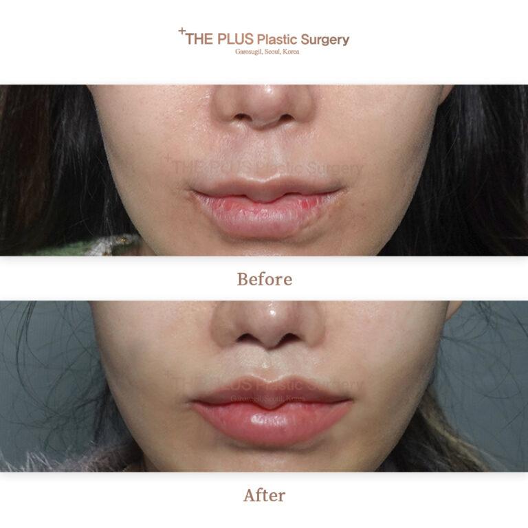 the plus philtrum reduction surgery