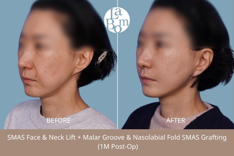 Before and After SMAS Facelift
