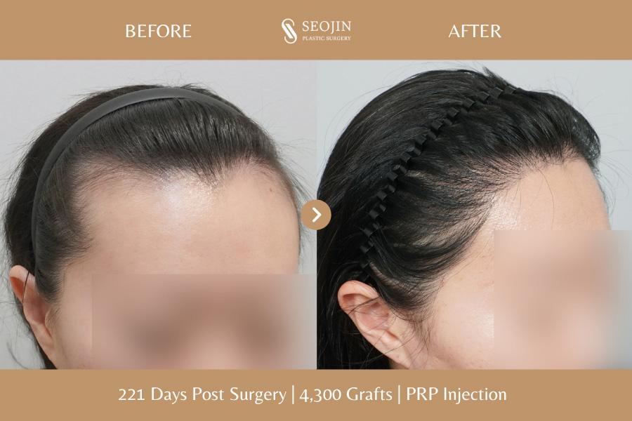 Seojin Plastic Surgery Clinic before and after image