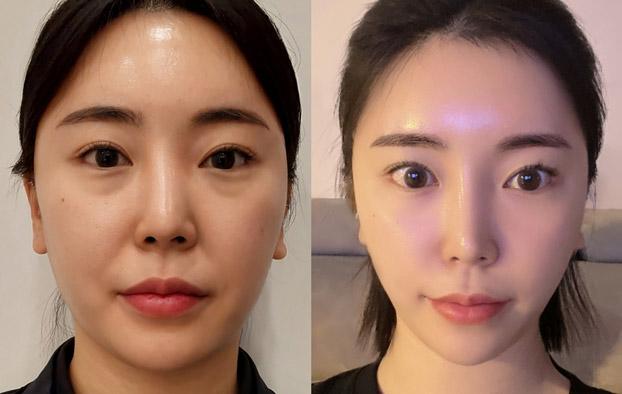 Female under eye mid face 1 month