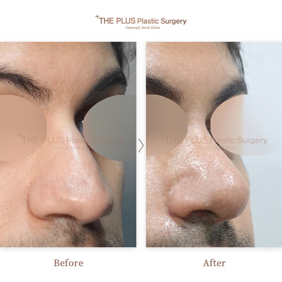 Primary Rhinoplasty & Hump Correction & No Silicone & Ear Cartilage & Septal Cartilage & Alar Reduction