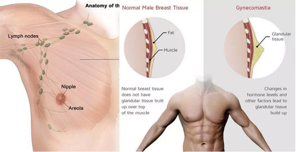 Gynecomastia