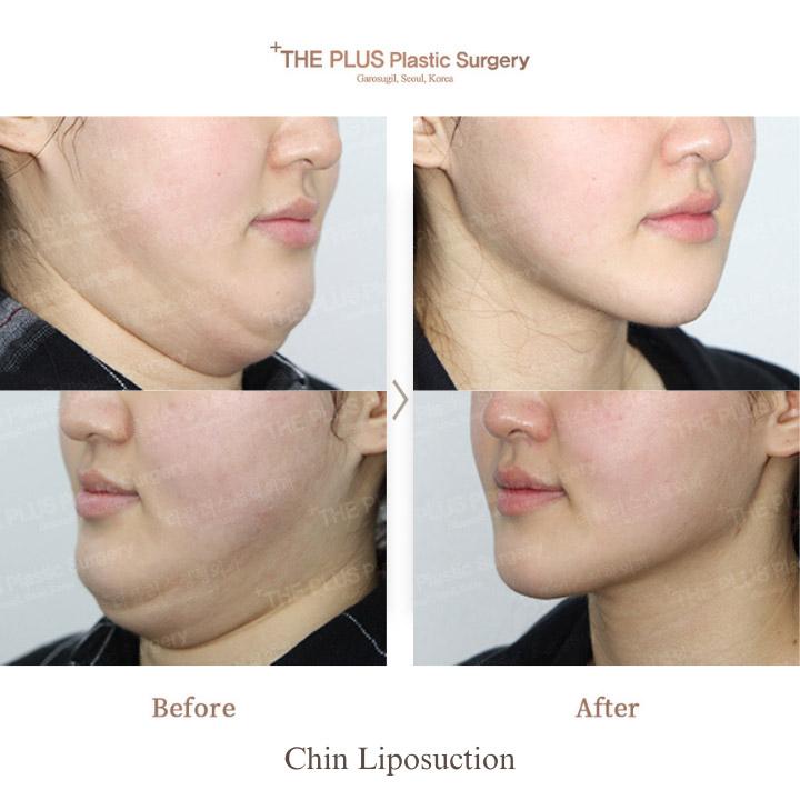 THEPLUS Plastic Surgery before and after image