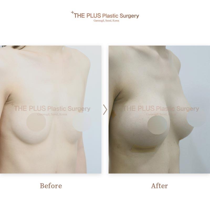 Breast augmentation with autologous fat grafting