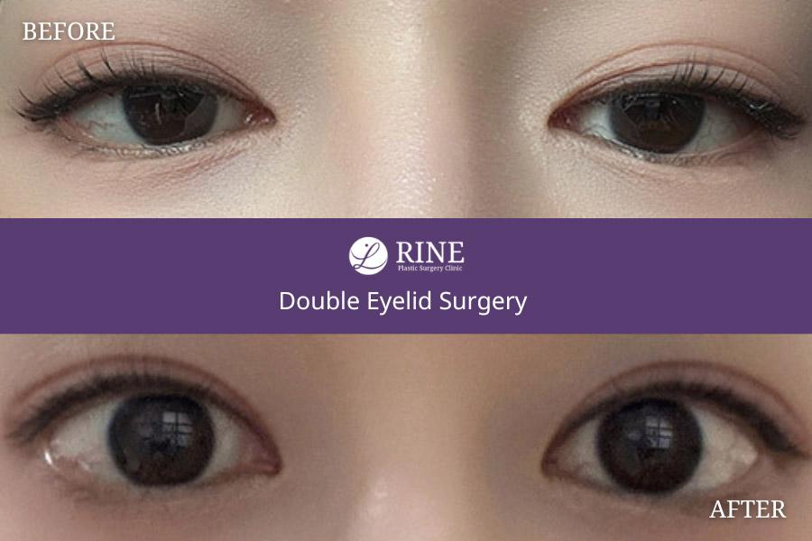 Double Eyelid Surgery